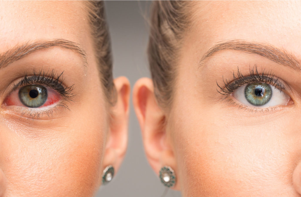 A dry, red eye next to a mirror image of a healthy, clear eye.