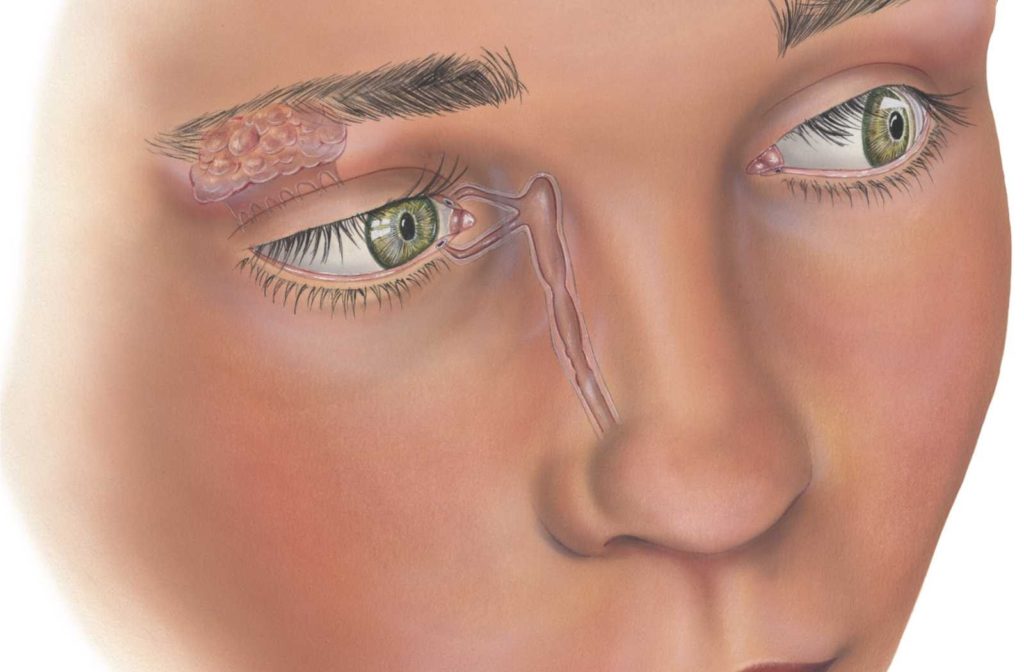 drawing of woman's face centered on puncta and other parts of the lacrimal system