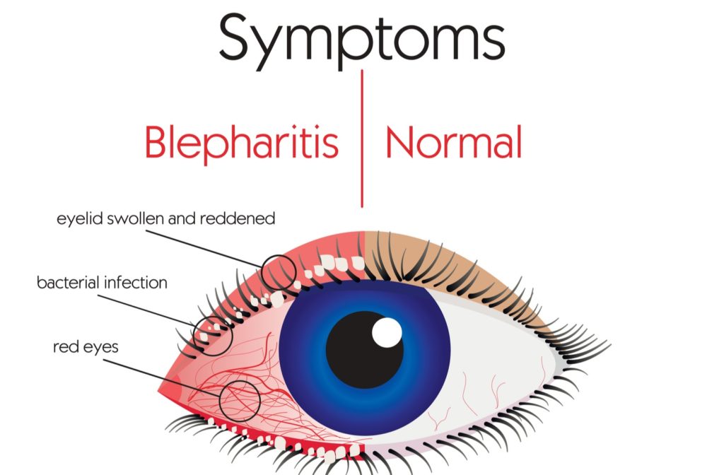 Diagram showing some common symptoms of blepharitis in comparison to normal eye
