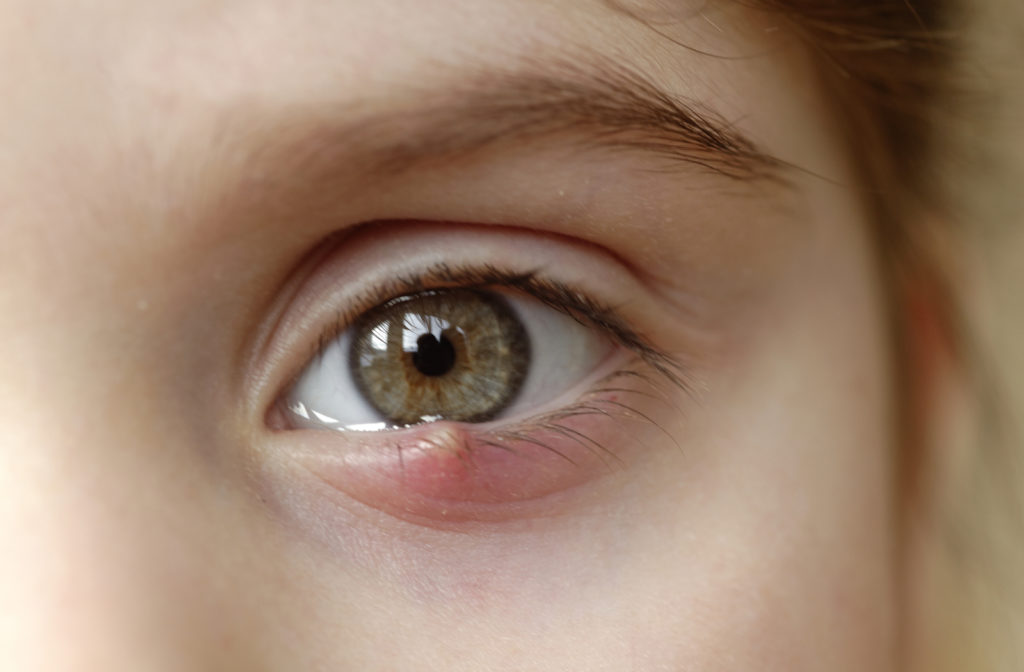 Young girl with stye on her eye due to the excess heat which is causing dry eye problems for her