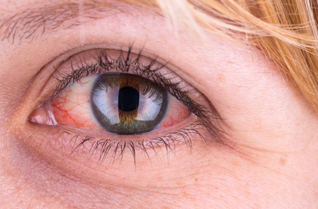 close up of women's eye with red eye with vessels close to breaking
